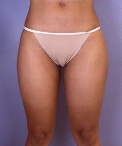 After: Hips/Outer Thighs