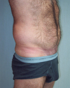Before: Abdomen