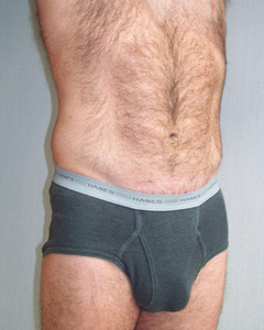 After: Abdomen